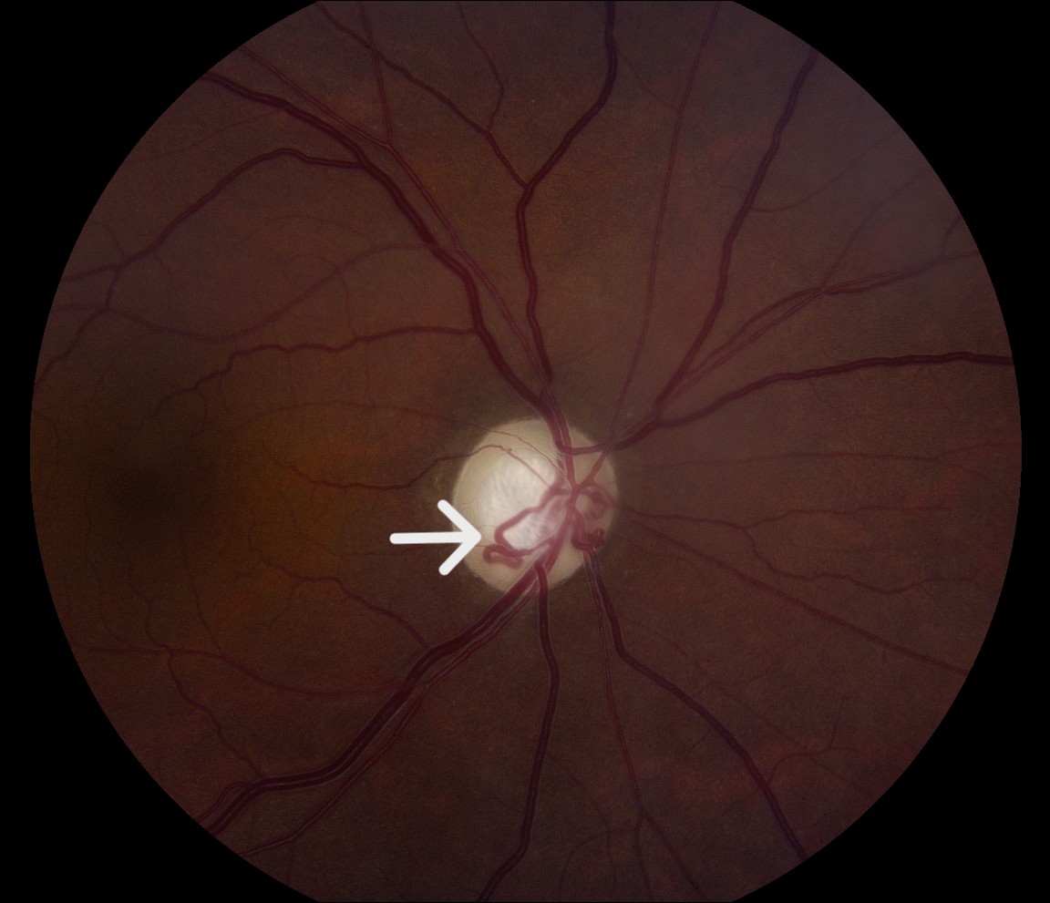 Fundus photo of right eye showing large optic discs with large deep cups, neuroretinal rim pallor, and optociliary shunt vessels (white arrow) 